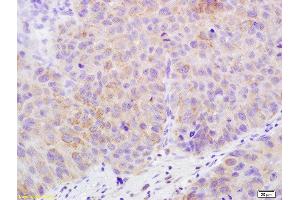 Formalin-fixed and paraffin embedded human bladder carcinoma labeled with Rabbit Anti-Claudin 17 Polyclonal Antibody, Unconjugated  at 1:200 followed by conjugation to the secondary antibody and DAB staining (Claudin 17 antibody  (AA 29-81))
