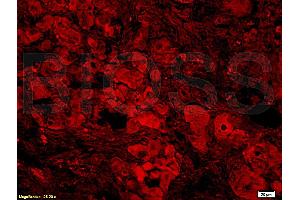 Formalin-fixed and paraffin-embedded: Human nasopharyngeal carcinoma labeled with Rabbit Anti-BAFF/CD257 Polyclonal Antibody, Unconjugated (ABIN740175) 1:400 followed by conjugation to the secondary antibody and DAB staining (BAFF antibody  (AA 221-309))