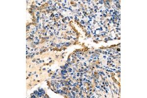 Immunohistochemistry analysis of paraffin embedded human lung cancer using syt1 (ABIN7075794) at dilution of 1: 2000 (SYT1 antibody)