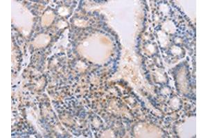 The image on the left is immunohistochemistry of paraffin-embedded Human thyroid cancer tissue using ABIN7130592(PFN4 Antibody) at dilution 1/20, on the right is treated with fusion protein. (Profilin 4 antibody)