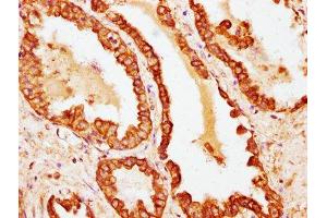 IHC image of ABIN7177373 diluted at 1:100 and staining in paraffin-embedded human prostate cancer performed on a Leica BondTM system. (Cytokeratin 18 antibody  (AA 200-423))