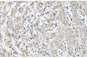 Immunohistochemistry of paraffin-embedded Human liver using Snail Polyclonal Antibody at dilution of 1:100 (40x lens). (SNAIL antibody)