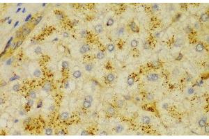 Immunohistochemistry of paraffin-embedded Human liver cancer using ACTN1 Polyclonal Antibody at dilution of 1:100 (40x lens).