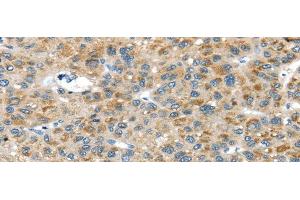 Immunohistochemistry of paraffin-embedded Human liver cancer tissue using USP9X Polyclonal Antibody at dilution 1:40