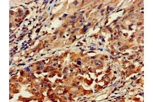 Immunohistochemistry of paraffin-embedded human lung cancer using ABIN7154711 at dilution of 1:100 (GNAT1 antibody  (AA 92-170))