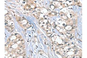 The image on the left is immunohistochemistry of paraffin-embedded Human breast cancer tissue using ABIN7192347(SGPL1 Antibody) at dilution 1/25, on the right is treated with synthetic peptide. (SGPL1 antibody)