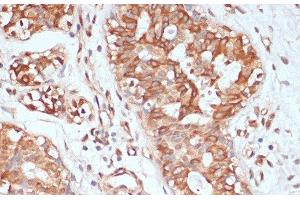 Immunohistochemistry of paraffin-embedded Human mammary cancer using PTPRN2 Polyclonal Antibody at dilution of 1:100 (40x lens).