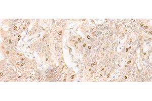 Immunohistochemistry of paraffin-embedded Human esophagus cancer tissue using IL7 Polyclonal Antibody at dilution of 1:30(x200) (IL-7 antibody)