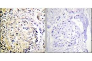 Immunohistochemistry analysis of paraffin-embedded human breast carcinoma tissue, using Vimentin (Ab-56) Antibody.