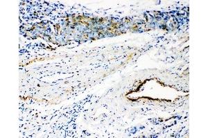 IHC-P: HYAL3 antibody testing of human breast cancer tissue