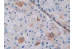 Detection of ABCA1 in Human Liver cancer Tissue using Polyclonal Antibody to ATP Binding Cassette Transporter A1 (ABCA1) (ABCA1 antibody  (AA 1385-1663))