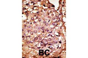 Formalin-fixed and paraffin-embedded human cancer tissue reacted with CCBP2 polyclonal antibody  , which was peroxidase-conjugated to the secondary antibody, followed by AEC staining. (CCBP2 antibody  (N-Term))