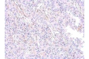 IHC-P Image MMP9 antibody [N2C1], Internal detects MMP9 protein at cytosol on AGS xenograft by immunohistochemical analysis. (MMP 9 antibody)