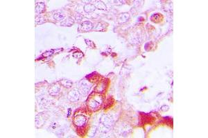 Immunohistochemical analysis of TRAF3IP3 staining in human lung cancer formalin fixed paraffin embedded tissue section. (TRAF3IP3 antibody  (Center))