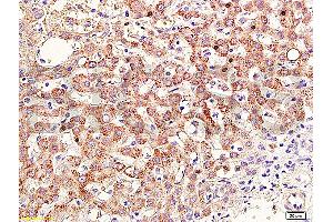Formalin-fixed and paraffin embedded human cervical carcinoma labeled with Anti-RAR Beta Polyclonal Antibody (ABIN669516), Unconjugated at 1:400, followed by conjugation to the secondary antibody and DAB staining (Retinoic Acid Receptor beta antibody  (AA 155-250))