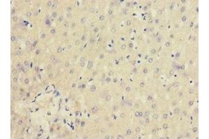 Immunohistochemistry of paraffin-embedded human liver cancer using ABIN7156847 at dilution of 1:100 (CD25 antibody  (AA 30-250))