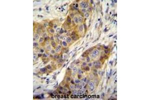 ANR39 Antibody (C-term) immunohistochemistry analysis in formalin fixed and paraffin embedded human breast carcinoma followed by peroxidase conjugation of the secondary antibody and DAB staining. (ANKRD39 antibody  (C-Term))