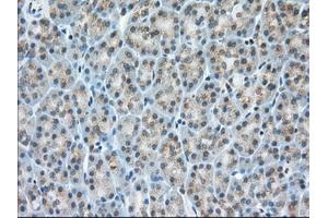 Immunohistochemical staining of paraffin-embedded Adenocarcinoma of Human colon tissue using anti-MIOX mouse monoclonal antibody. (MIOX antibody)