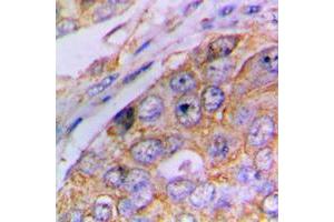 Immunohistochemical analysis of Caspase 4 p20 staining in human lung cancer formalin fixed paraffin embedded tissue section. (Caspase 4 p20 (Center) antibody)