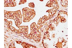 IHC image of ABIN7146454 diluted at 1:200 and staining in paraffin-embedded human prostate cancer performed on a Leica BondTM system.