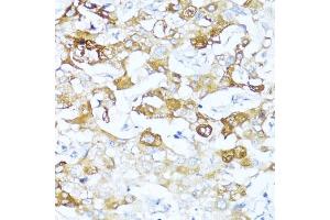 Immunohistochemistry of paraffin-embedded human liver cancer using Alpha-1 Antichymotrypsin (Alpha-1 Antichymotrypsin (SERPIN)) antibody (ABIN3016733, ABIN3016734, ABIN3016735 and ABIN6219829) at dilution of 1:100 (40x lens). (SERPINA3 antibody  (AA 24-423))