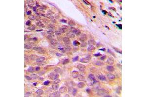 Immunohistochemical analysis of Kanadaptin staining in human breast cancer formalin fixed paraffin embedded tissue section. (NADAP antibody  (Center))
