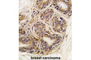Formalin-fixed and paraffin-embedded human breast carcinomareacted with CASC3 (phospho Y181) polyclonal antibody , which was peroxidase-conjugated to the secondary antibody, followed by AEC staining. (CASC3 antibody  (pTyr181))
