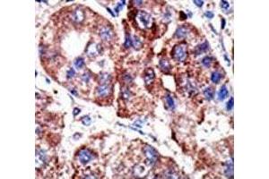 IHC analysis of FFPE human hepatocarcinoma tissue stained with the p62 antibody (SQSTM1 antibody  (AA 317-346))