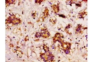 IHC image of ABIN7150414 diluted at 1:200 and staining in paraffin-embedded human breast cancer performed on a Leica BondTM system. (CD3EAP antibody  (AA 289-404))