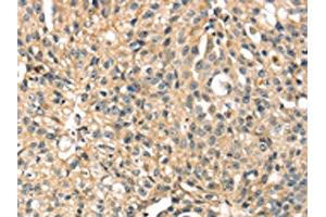 The image on the left is immunohistochemistry of paraffin-embedded Human breast cancer tissue using ABIN7131243(STX8 Antibody) at dilution 1/35, on the right is treated with fusion protein. (STX8 antibody)