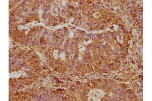 IHC image of ABIN7170987 diluted at 1:500 and staining in paraffin-embedded human colon cancer performed on a Leica BondTM system. (ST5 antibody  (AA 3-280))