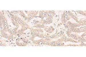 Immunohistochemistry of paraffin-embedded Human liver cancer tissue using ENO4 Polyclonal Antibody at dilution of 1:30(x200)