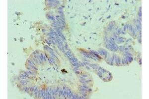 Immunohistochemistry of paraffin-embedded human colon cancer using ABIN7156372 at dilution of 1:100 (IGFBP4 antibody  (AA 22-258))