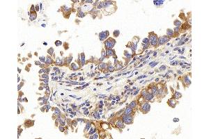 Immunohistochemistry analysis of paraffin-embedded human lung cancer using PERK Polyclonal Antibody at dilution of 1:400. (PERK antibody)