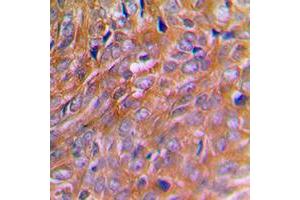 Immunohistochemical analysis of BNIP2 staining in human breast cancer formalin fixed paraffin embedded tissue section. (BNIP2 antibody  (Center))