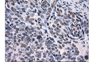 Immunohistochemical staining of paraffin-embedded Adenocarcinoma of colon tissue using anti-RPA2 mouse monoclonal antibody. (RPA2 antibody)