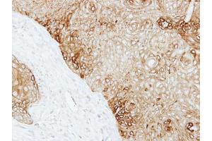 IHC-P Image Immunohistochemical analysis of paraffin-embedded Cal27 xenograft, using Cytokeratin 13, antibody at 1:500 dilution.