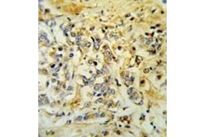 Immunohistochemistry analysis in formalin fixed and paraffin embedded breast carcinoma reacted with LMBR1L Antibody (C-term) followed which was peroxidase conjugated to the secondary antibody and followed by DAB staining.