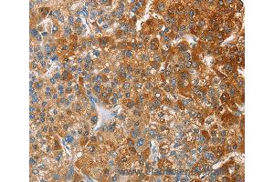 Immunohistochemistry of Human thyroid cancer using CD200R1 Polyclonal Antibody at dilution of 1:60 (HCRTR2 antibody)