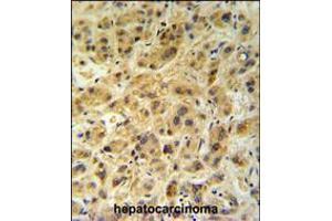 GNS Antibody (Center N189) IHC analysis in formalin fixed and paraffin embedded human hepatocarcinoma followed by peroxidase conjugation of the secondary antibody and DAB staining. (GNS antibody  (AA 174-203))