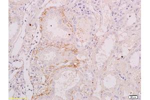 Formalin-fixed and paraffin embedded human renal carcinoma labeled with Anti-BAFFR/CD268 Polyclonal Antibody, Unconjugated (ABIN740760) at 1:200 followed by conjugation to the secondary antibody (TNFRSF13C antibody  (AA 121-184))