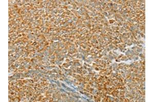The image on the left is immunohistochemistry of paraffin-embedded Human ovarian cancer tissue using ABIN7130771(PTPN22 Antibody) at dilution 1/20, on the right is treated with fusion protein. (PTPN22 antibody)
