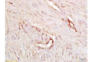 Formalin-fixed and paraffin embedded human endometrium carcinoma labeled with Anti P-cadherin Polyclonal Antibody, Unconjugated  at 1:200 followed by conjugation to the secondary antibody and DAB staining. (P-Cadherin antibody  (AA 625-725))