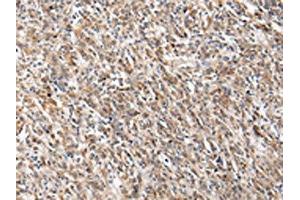 The image on the left is immunohistochemistry of paraffin-embedded Human gastric cancer tissue using ABIN7130604(PGRMC2 Antibody) at dilution 1/20, on the right is treated with fusion protein. (PGRMC2 antibody)