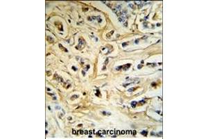 CASA Antibody (Center) (R) IHC analysis in formalin fixed and paraffin embedded human breast carcinoma tissue followed by peroxidase conjugation of the secondary antibody and DAB staining. (Casein alpha S1 antibody  (AA 42-70))