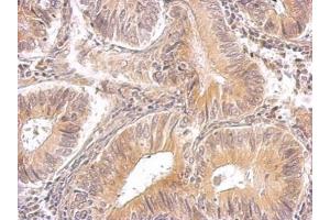 IHC-P Image RRM1 antibody detects RRM1 protein on human gastric cancer by immunohistochemical analysis. (RRM1 antibody  (Center))