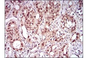Immunohistochemical analysis of paraffin-embedded cervical cancer tissues using NBN mouse mAb with DAB staining.