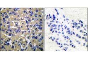 Immunohistochemistry analysis of paraffin-embedded human breast carcinoma tissue, using WNK1 (Ab-58) Antibody. (WNK1 antibody  (AA 24-73))