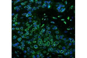 IF analysis of Emerin using anti-Emerin antibody (ABIN4886569) Emerin was detected in paraffin-embedded section of human oesophagus squama cancer tissues. (Emerin antibody  (N-Term))