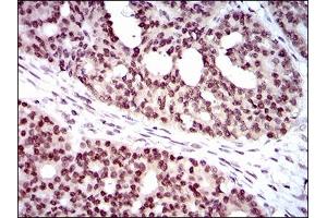 Immunohistochemical analysis of paraffin-embedded ovarian cancer tissues using WHSC2 mouse mAb with DAB staining.